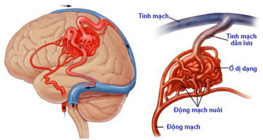 Biến chứng của dị dạng mạch máu não
