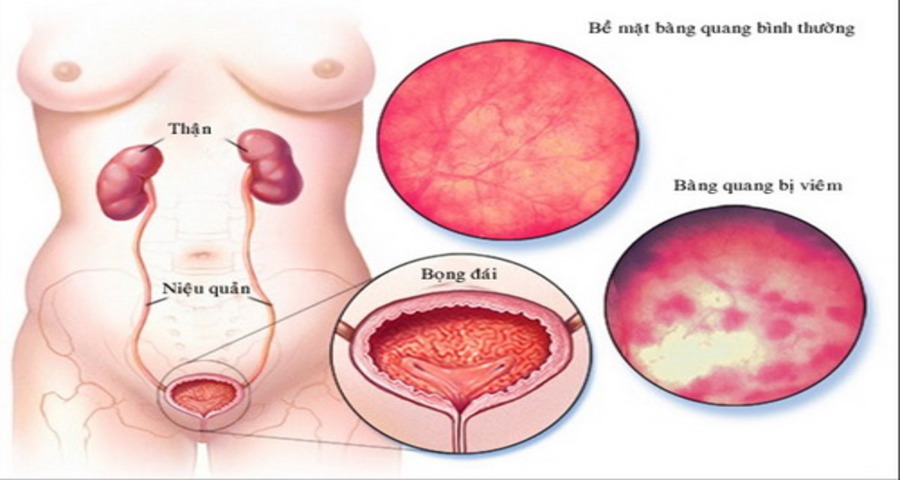 Tổng quan về bệnh lao hệ tiết niệu sinh dục